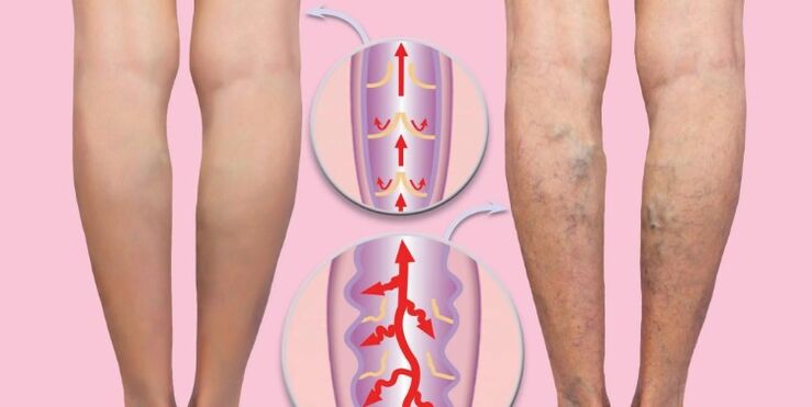 veselīgas un varikozas vēnas uz kājām